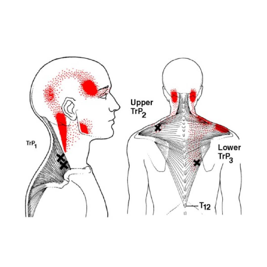Trigger pointy: co to je, proč vznikají a jak se léčí